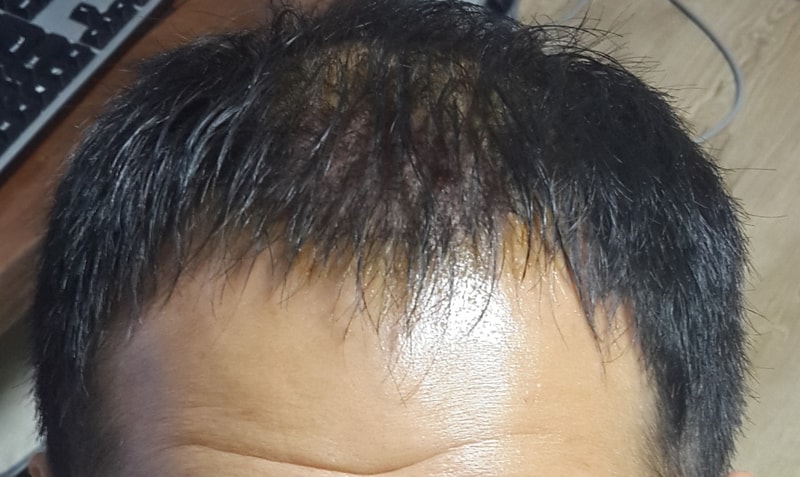 수술후2일째-.jpg