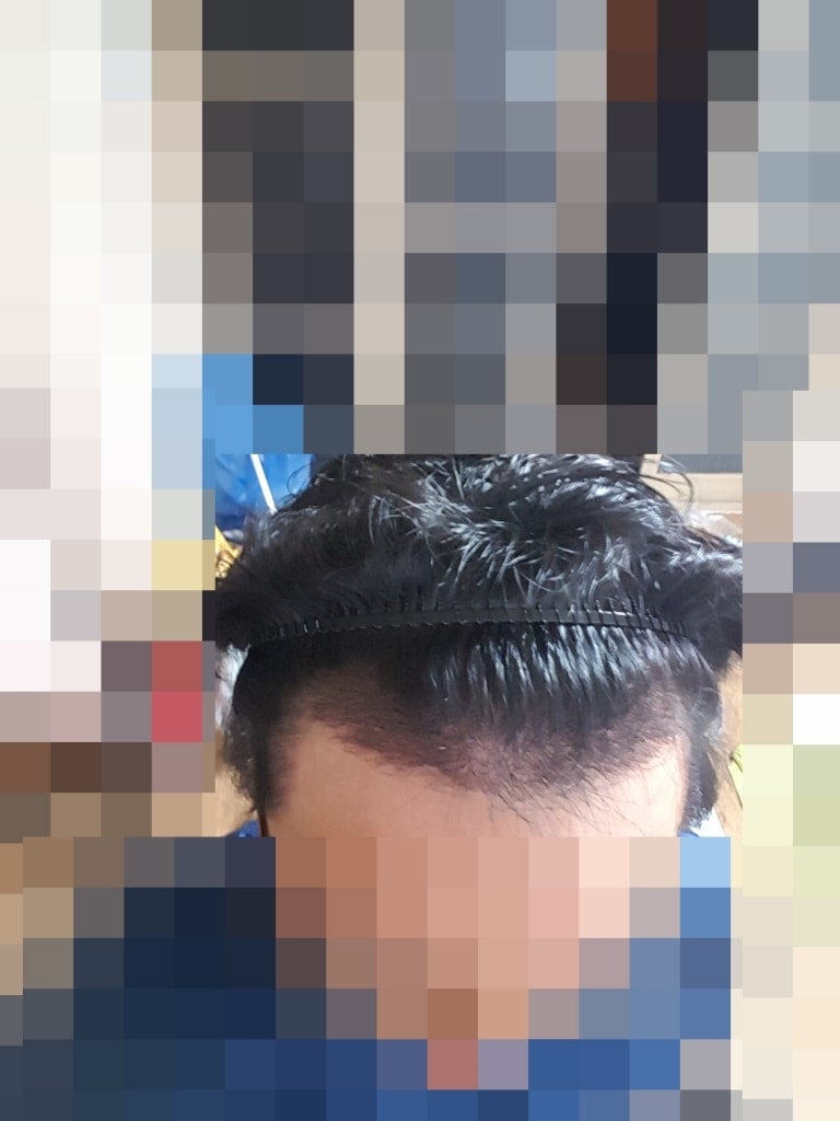 I received the hair transplant quickly and well.