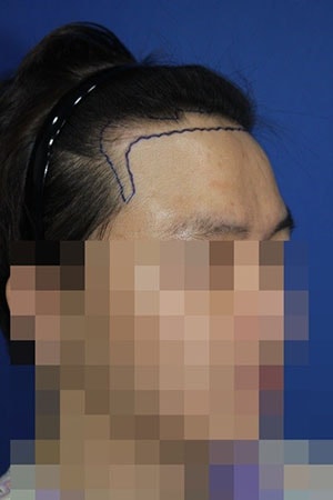 3.수술전.jpg