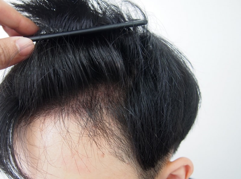 It's the fourth month of maternal 1300 hair follicle transplantation.