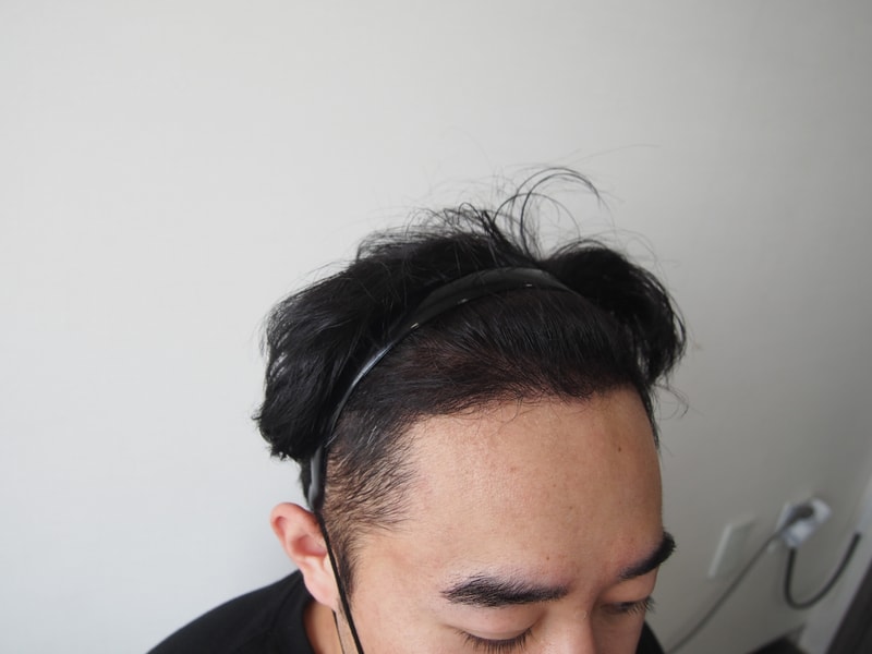 In the 4th month of the post-mortem surgery of 3,200mo 1,600 hair follicles at Mo Jae-sung Hospital.. It's a little late;