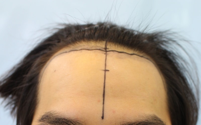 Hair transplant incision 3300 Mo 9 months old photo