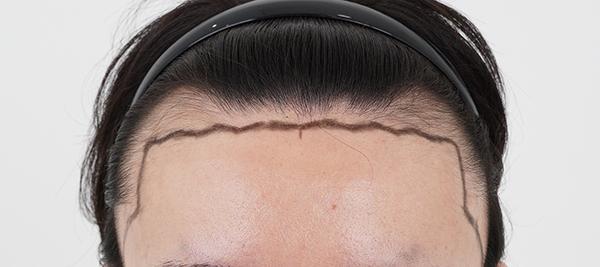 Busan Momo Clinic's second week review of 4,000-mo incision surgery