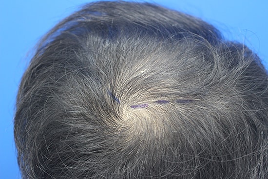 I got a 2,000-mo Hair Transplant on the top of the head that's gradually falling out.