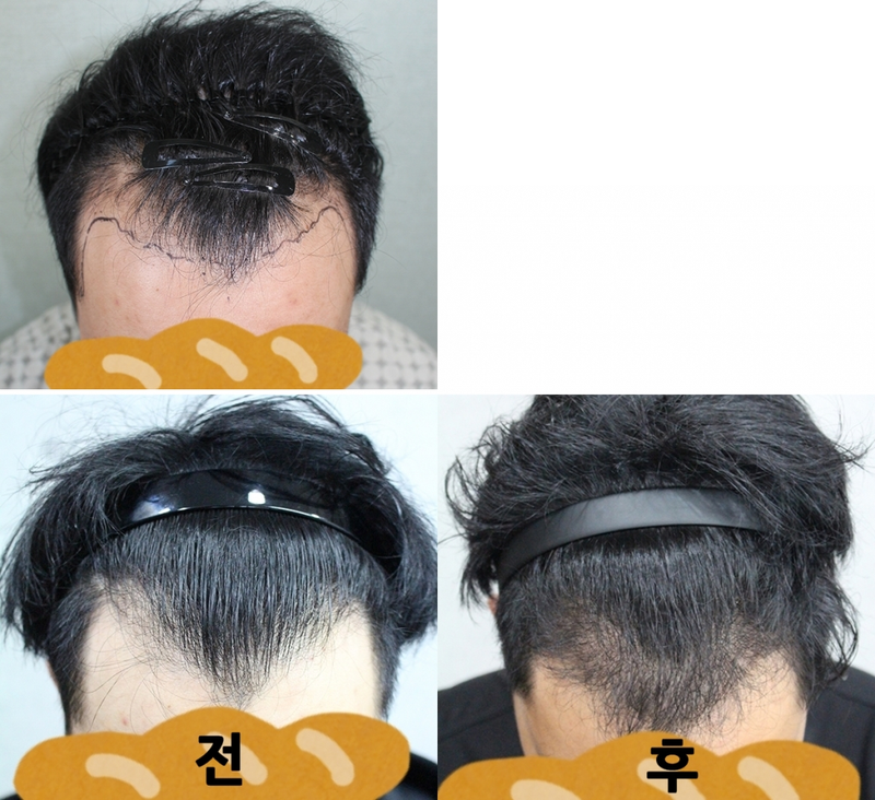 M-shaped hair loss incision. 3,000 hair loss. It's been 6 months