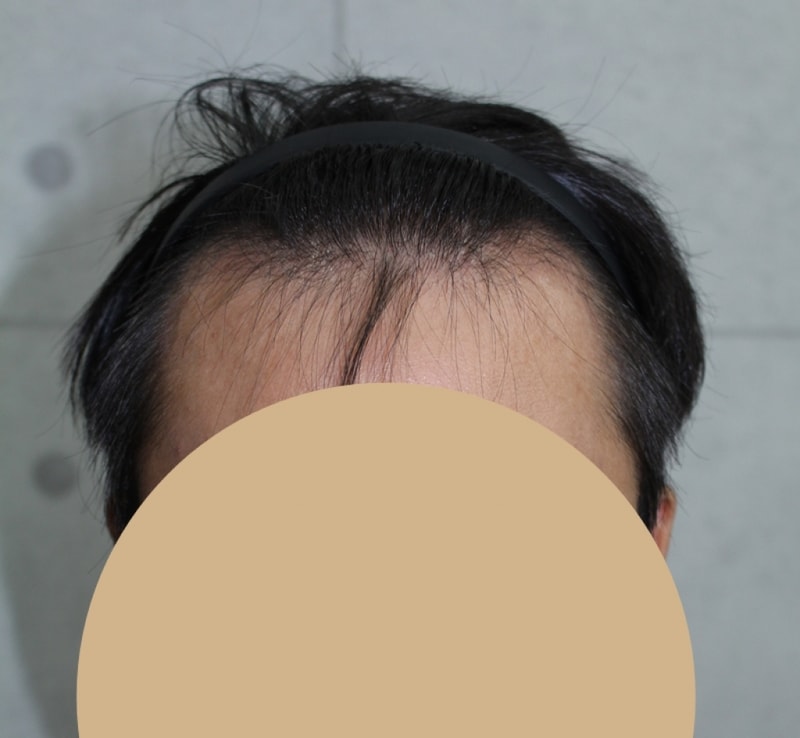 切开3500毛…. M型脱发已经两个月了。