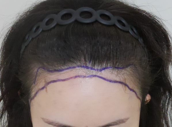 ヘアライン矯正1年目のレビュー