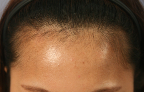 A review of hairline Hair Transplant in 1 year and 6 months.