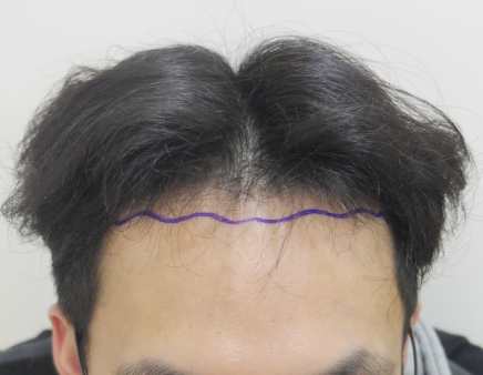 헤어라인 모발이식 후기 써봅니다