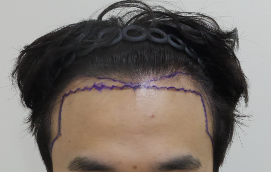 M字ヘアラインの毛髪移植から1年が経つと確実に満足できます
