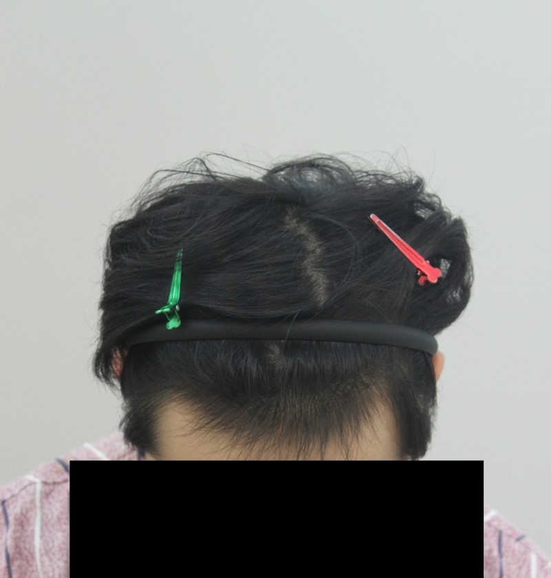 托前辈们的福 我顺利接受了手术