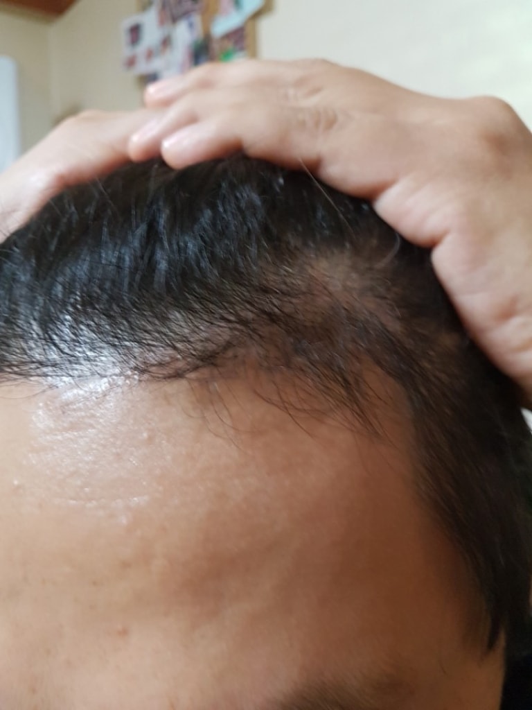 暗黒期が終わってからポヘア非切開6ヶ月です。