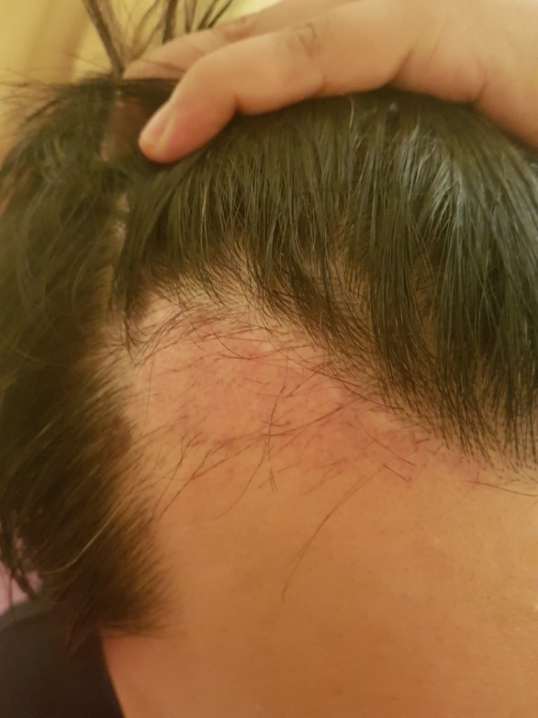 今やっとフォト評価に残すんですが、 ポヘア非切開が2ヵ月になりました