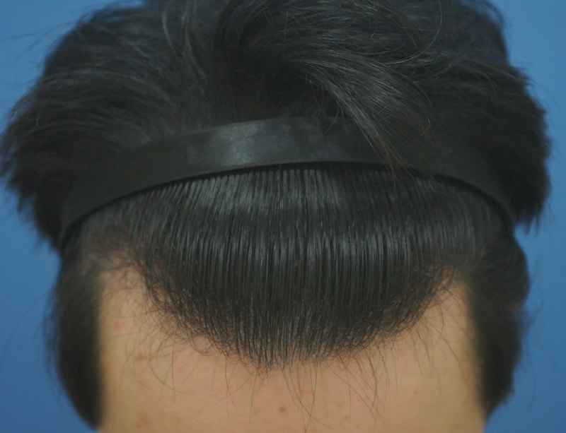 釜山ポヘア非切開スリット手術評価2ヶ月目です