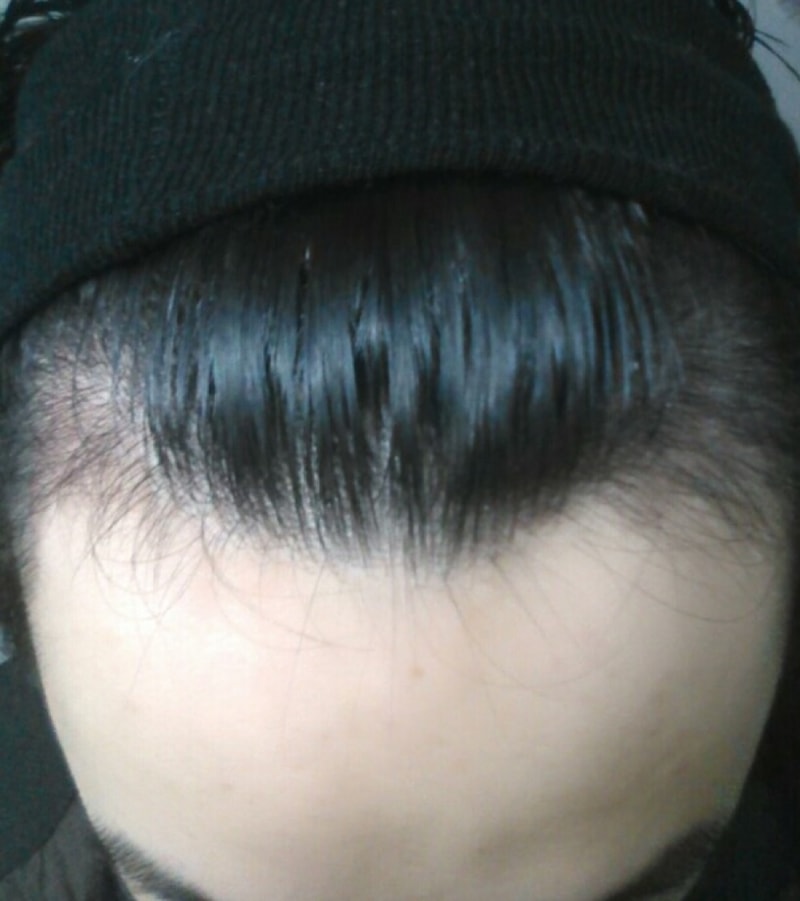 釜山ポヘア非切開スリット手術評価3ヶ月目です