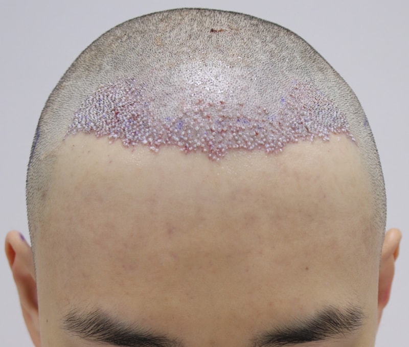 수술후1.JPG