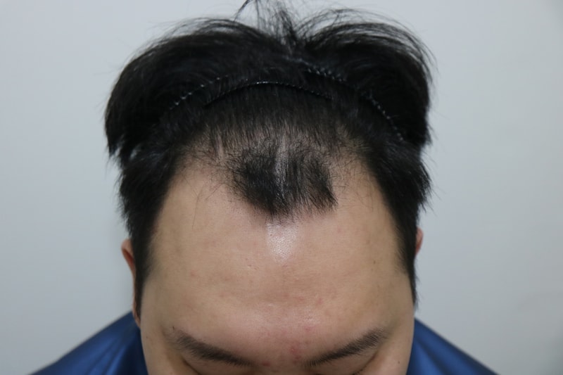 非切开隐形剪发移植 3500 毛发 1年后期