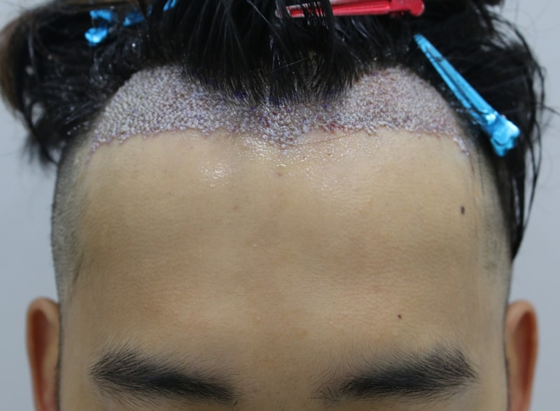 수술후.JPG