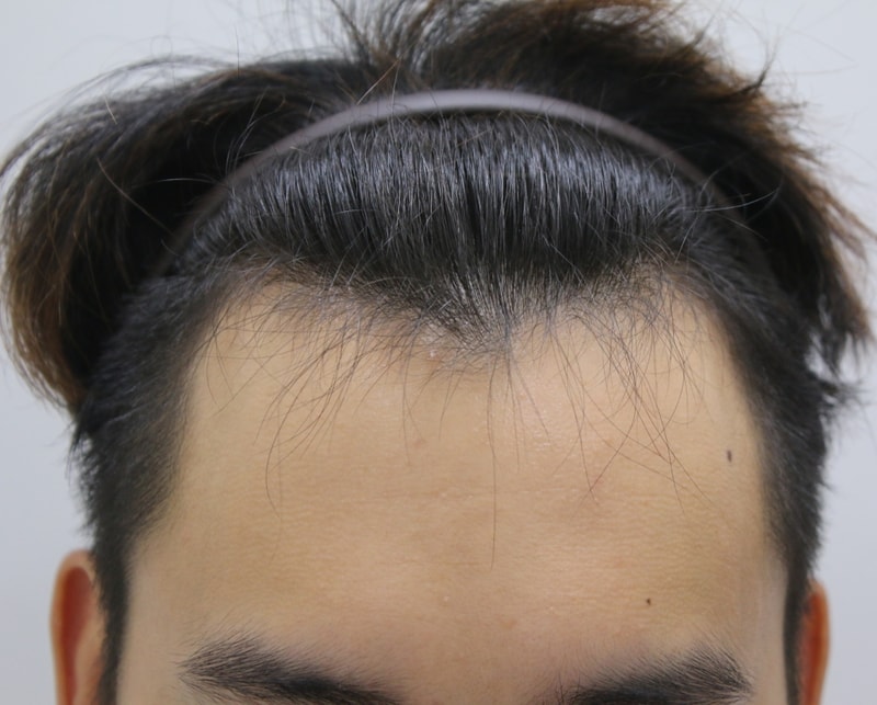I had surgery on the forehair less than a week ago