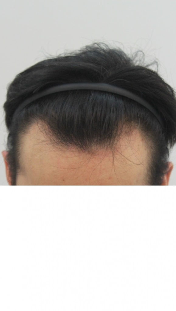 1760 hair follicle ㅍ hhh review