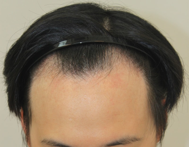 I got a non-cut hair surgery in Gangnam