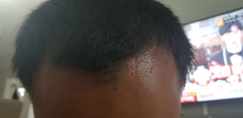 (Daegu forehair) Both the shell and the dead skin cells fall off