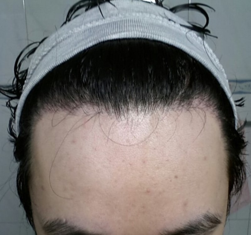 釜山ポヘア非切開スリット手術評価6ヶ月目です