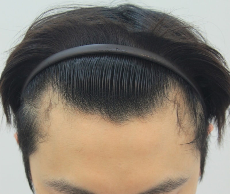 I'm finally getting surgery I had 1289 hair follicles