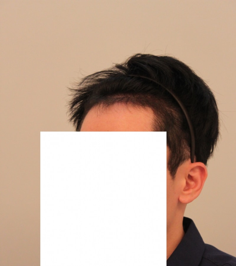 M字手术1200毛囊黑暗期结束。