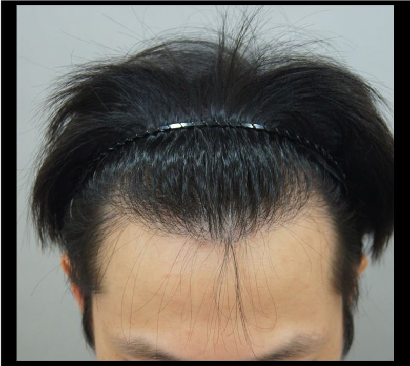 ポヘア釜山店でM字脱毛の手術を受けました