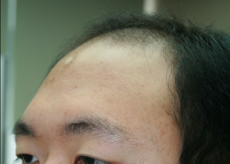 Forehead 2100 hair follicles 240 days have passed.