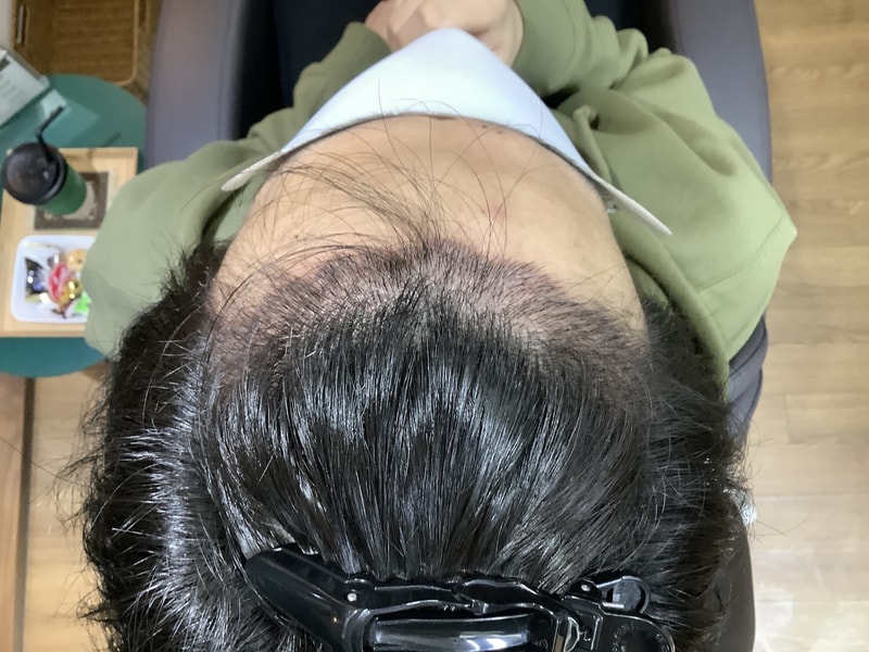ZARADA医院手术第14天后期