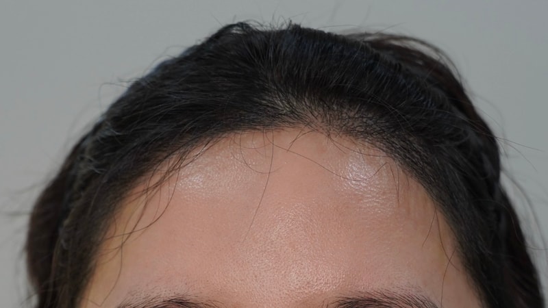 소개팅, 면접장에서도 칭찬받는 이마라인 (절개 모발이식 강추)