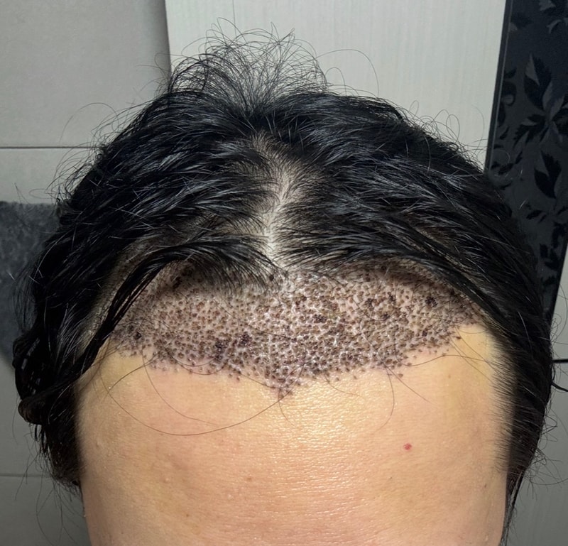 뉴헤어 모발이식 히든컷 1800모낭 후기