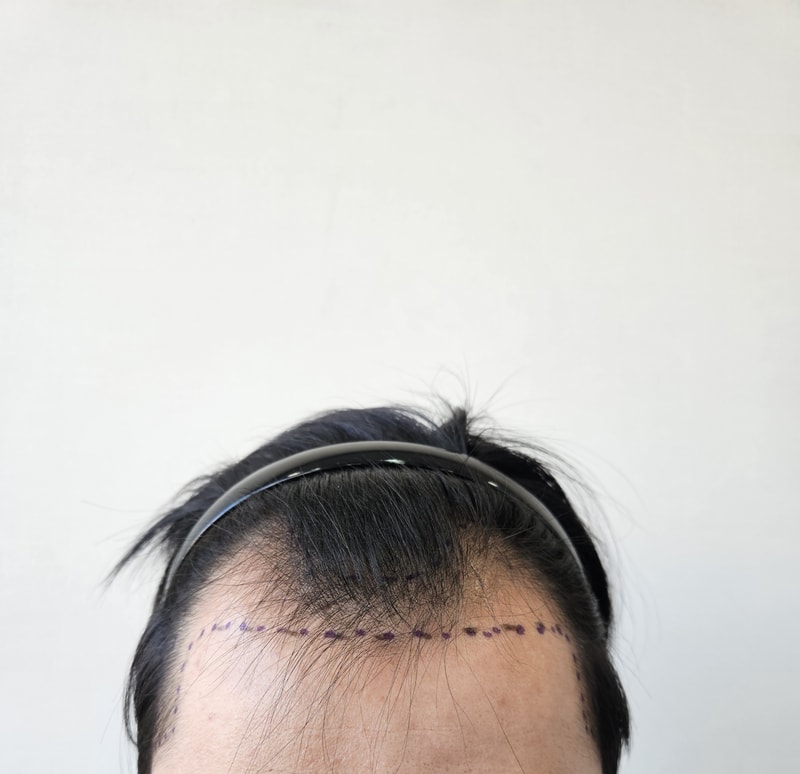 모발이식 수술 직후 0일차