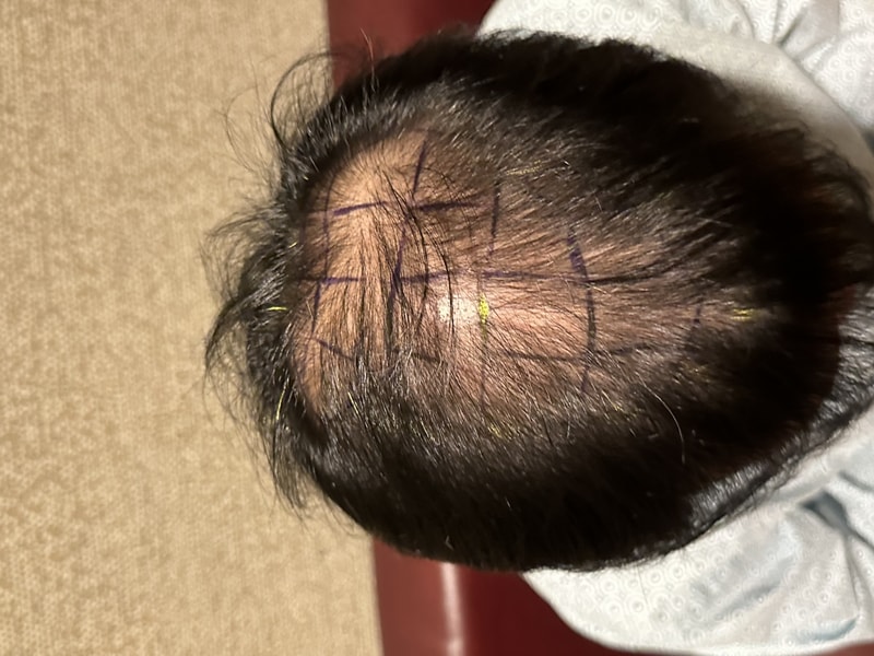 New Hair Hair Plastic Surgery Day 3 Non-Cutted Hair Transplantation Review~ [Emple 2000 Hair follicles]