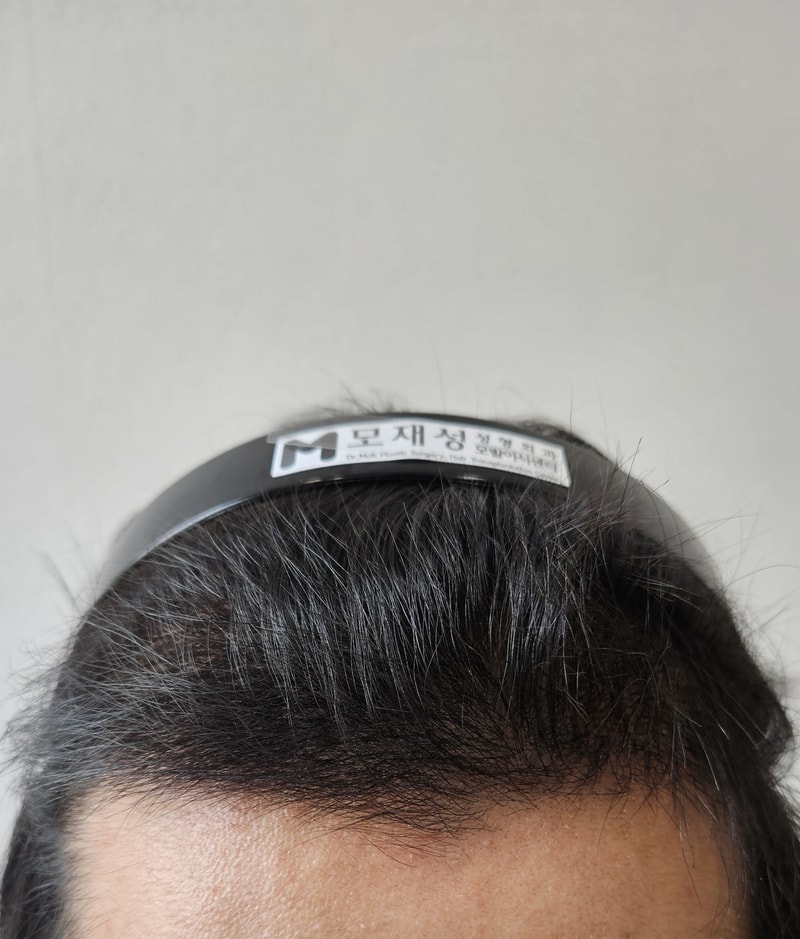 모발이식 4개월 차 후기