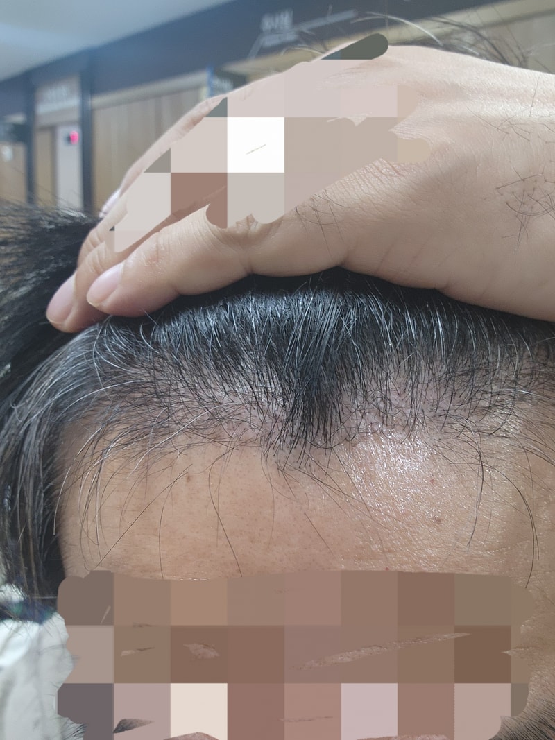 New Hair Hair Transplantation 1600 Hair follicles 3 Months Late