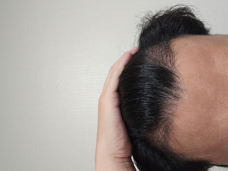 [모먼트의원] 비절개히든컷 3개월차(104일) 후기입니다.