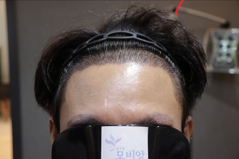 광주 압구정 모비앙의원 모발이식 2주경과 후기