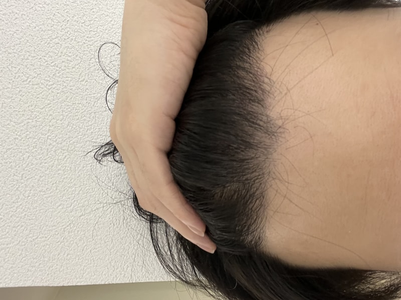 母材性手术1年后期。
