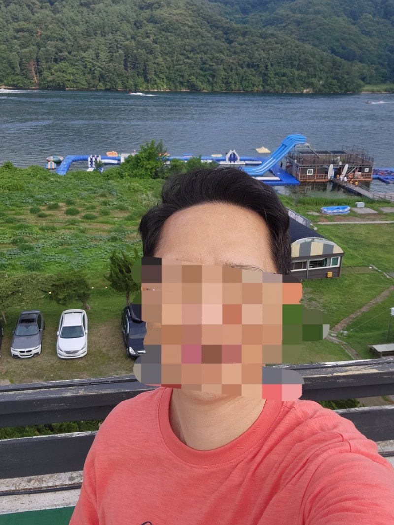 다나성형외과/무삭발/비절개/전두부위주/2300모낭/대량이식 14개월차 경과