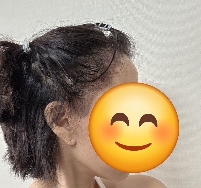 Apgujeong Mo Woo-rim Clinic Women's Hairline 2500 hairline incision