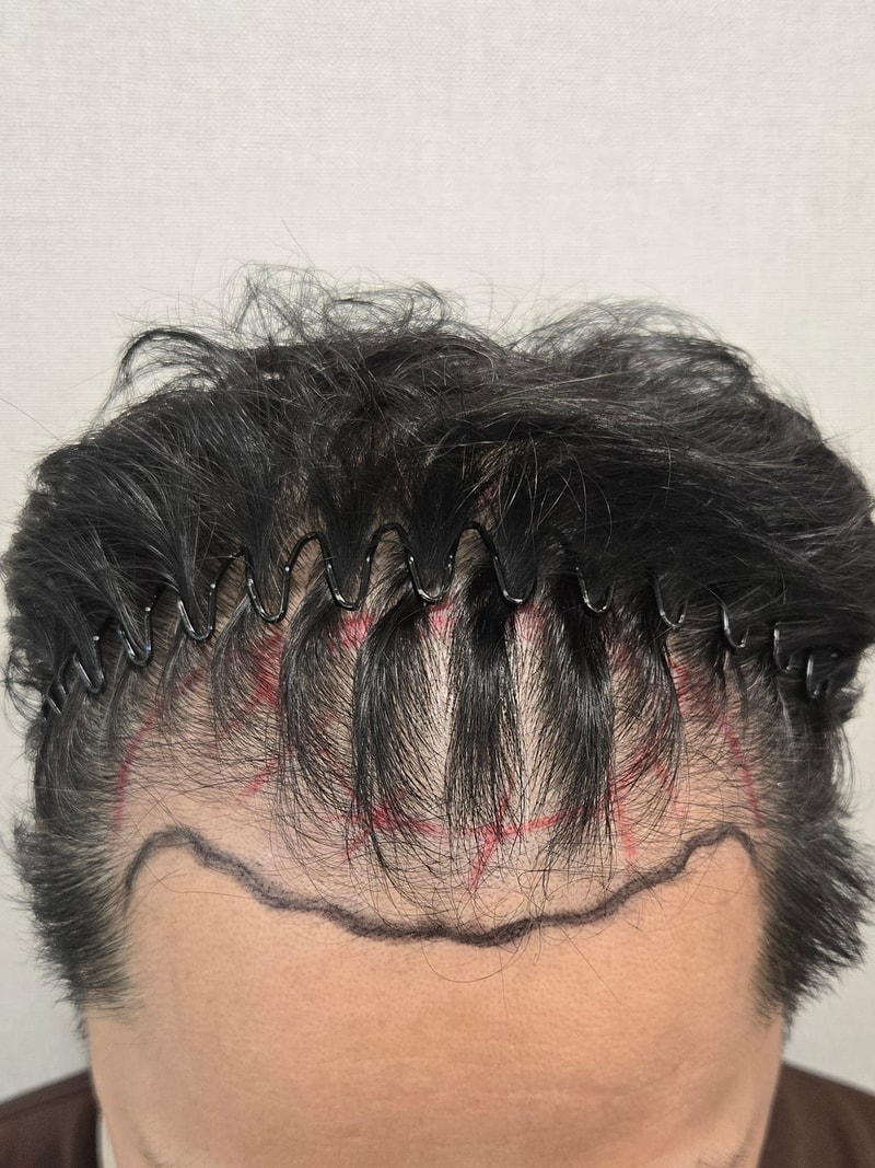 3000모 비절개 이식 후기