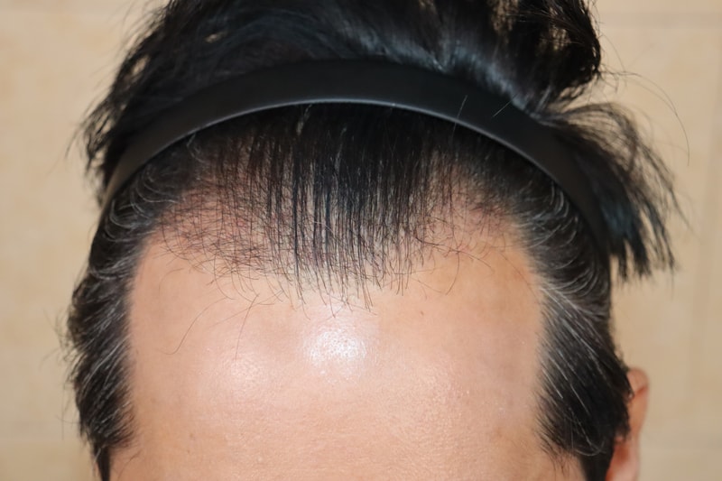 Umchan / Day 38 of incisional review