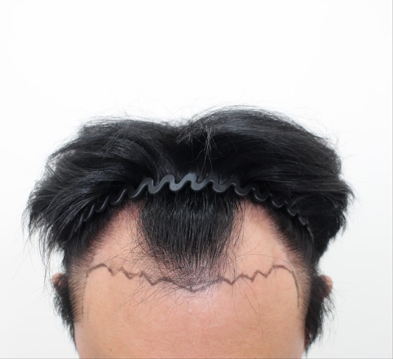 비절개 모발이식_6개월 경과 후기