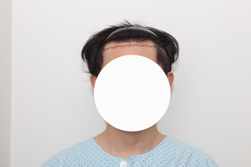 뉴헤어 서울점 투블럭 비절개 1200모낭 1년 1개월 후기