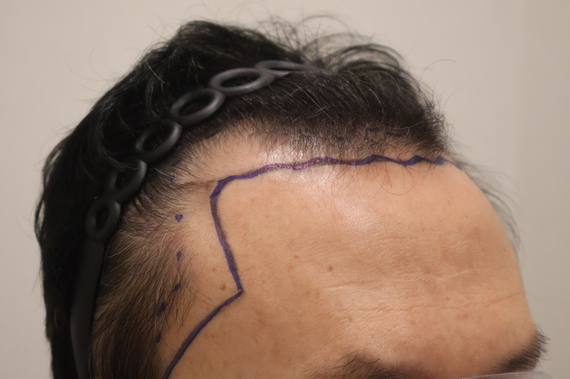 동탄 헤어로의원 2주차 모발이식 후기