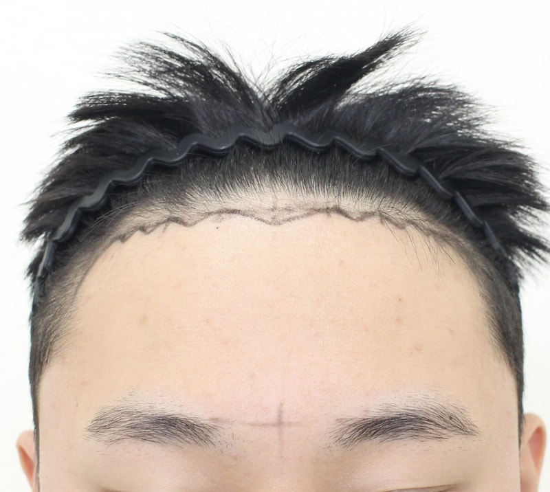 *모프로의원* 헤어라인 모발이식 비절개 2500모 6달차 경과
