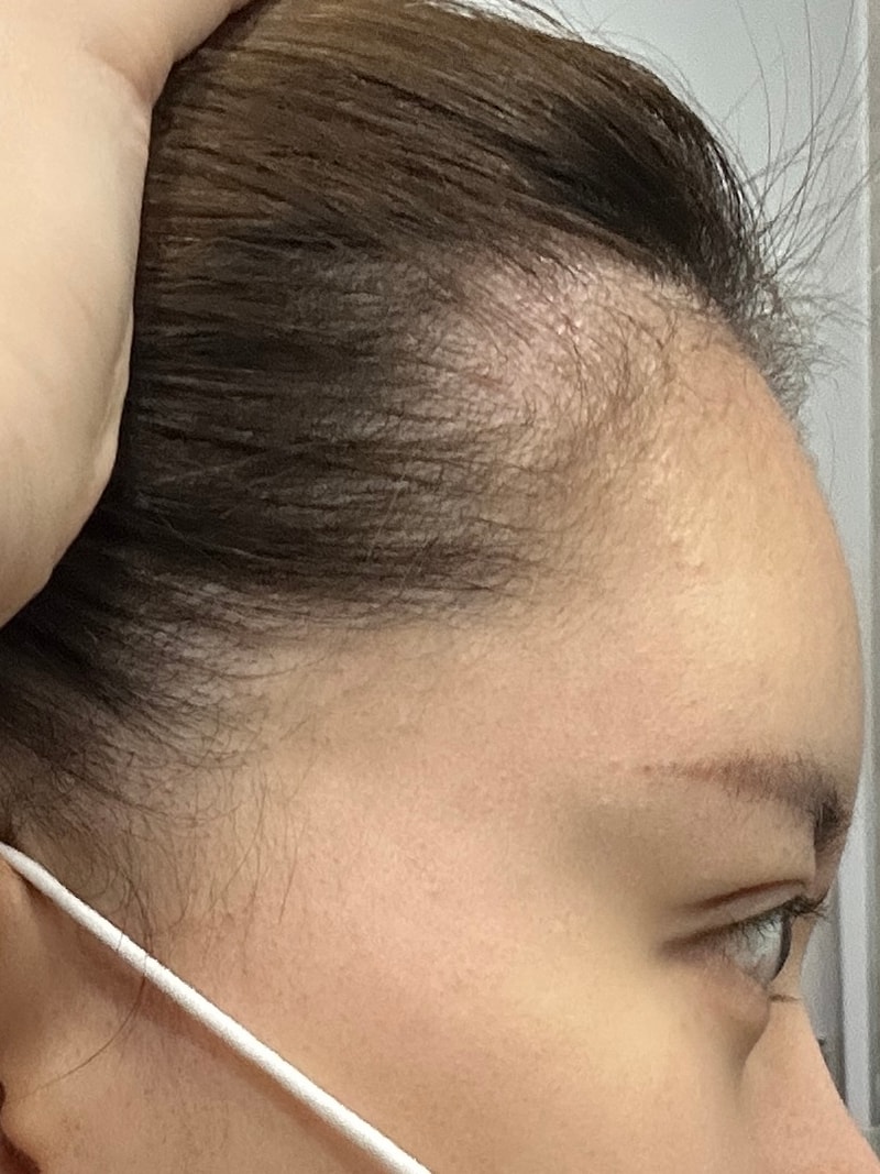 헤어라인 모발이식